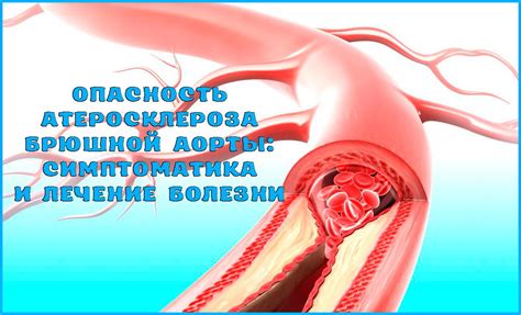 Атеросклероз аорты: понимание начальных симптомов