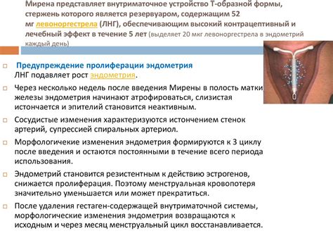 Внутриматочное устройство (ВМУ)