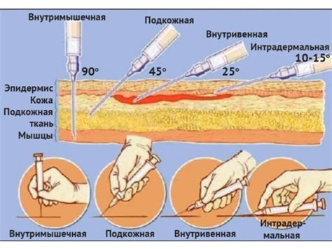 Выбор места инъекции