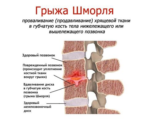 Грыжи шморля: основные причины появления