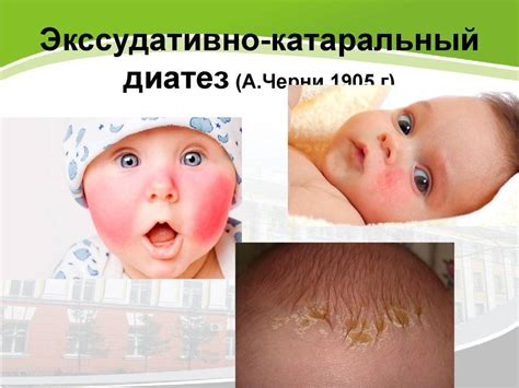 Диатез у детей: профилактика и лечение