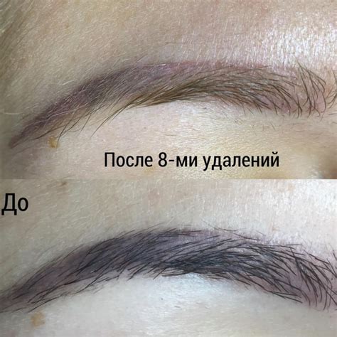 Использование специальных средств для снятия татуажа