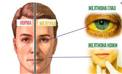 Какие заболевания могут вызывать желтый оттенок лица