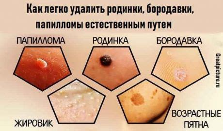 Как отличить жировик от других опухолей