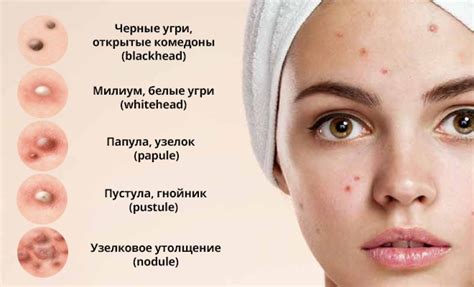 Медикаментозное и косметическое лечение прыщей у женщин