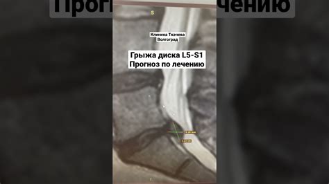 Медикаментозное лечение грыжи диска L5 S1 секвестрированной
