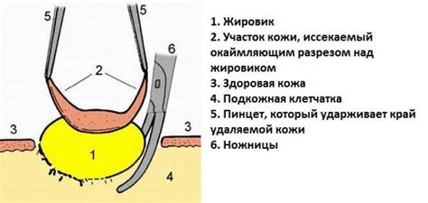 Методы выявления жировика