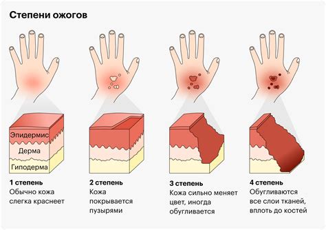 Мозоль от ожога