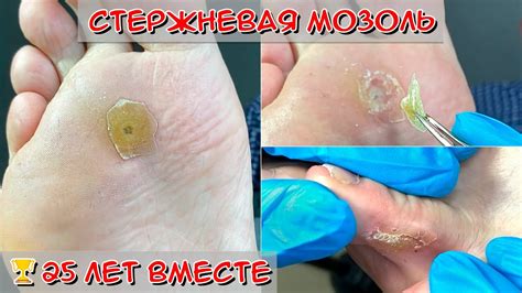 Мозоль от сдавливания
