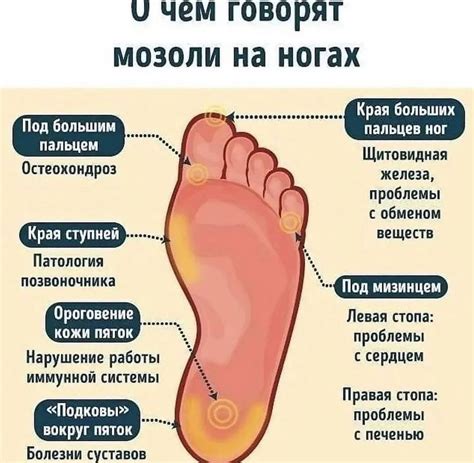 Мозоль от трения