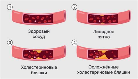 Основные признаки начальной стадии атеросклероза аорты: что обратить внимание