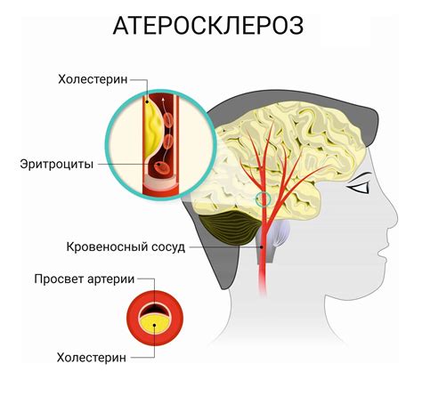 Первые симптомы атеросклероза аорты: распространенные признаки