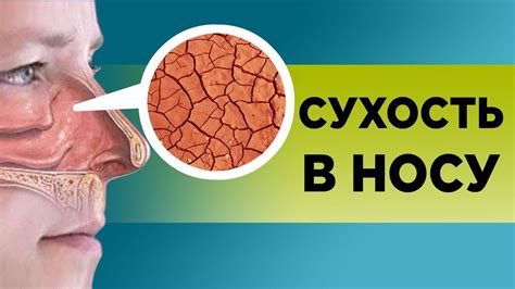 Почему возникает жжение и сухость в носу