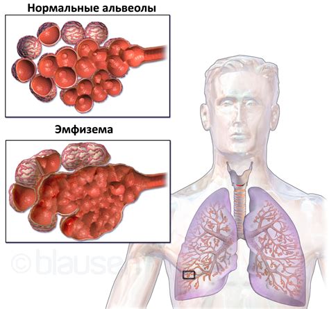 Причины возникновения грыжи в легких