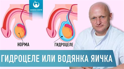 Причины возникновения поднятого яичка у мужчин