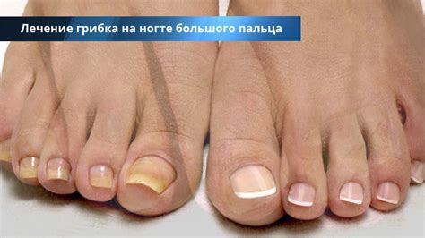 Причины и факторы развития грибка стопы