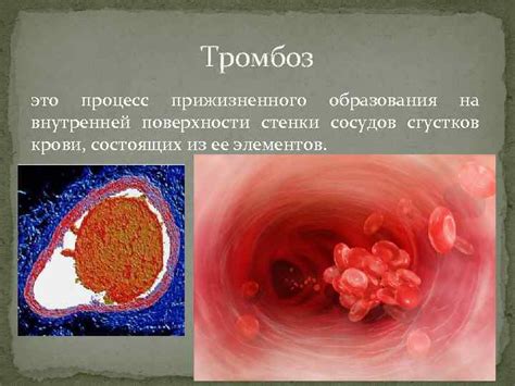 Причины образования сгустков