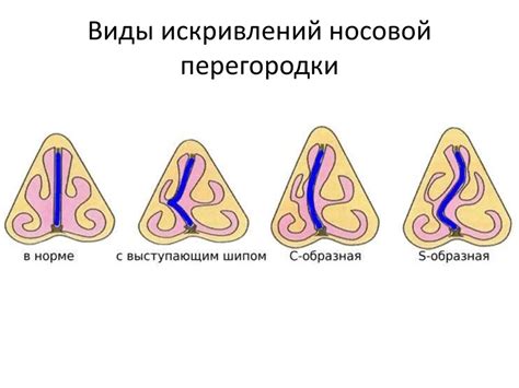Причины расщепления листков перегородки