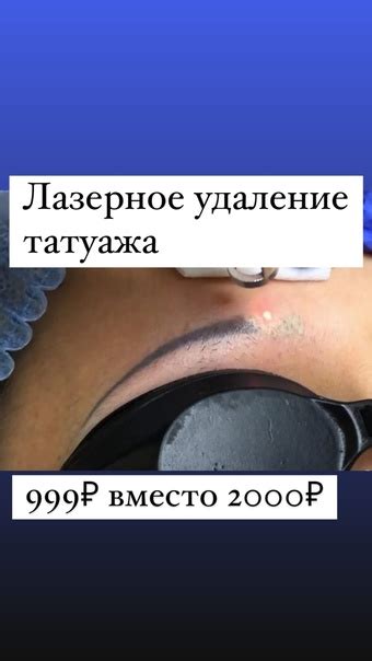 Процедура удаления татуажа лазером