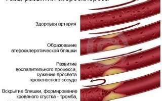 Ранние признаки атеросклероза аорты: что следует знать