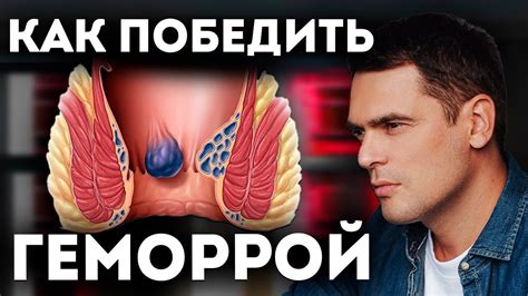 Риск развития геморроя и запоров