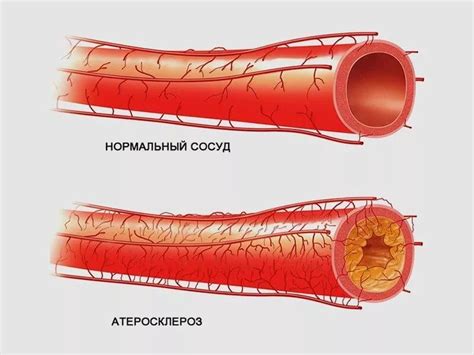 Характерные проявления атеросклероза аорты и их важность