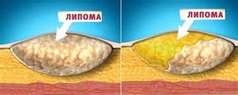 Что такое жировик