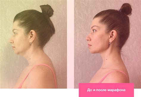 Начальные упражнения с бутылкой для устранения горба на шее