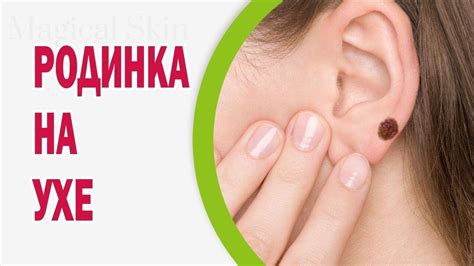 Предосторожности и дополнительные рекомендации по удалению йода из уха