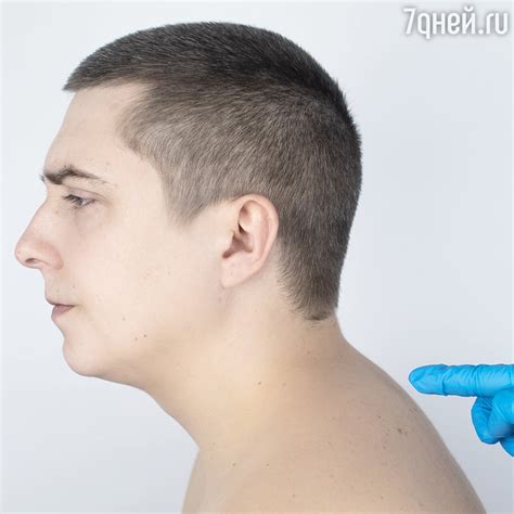 Устранение горба на шее с помощью бутылки: проблема и причины