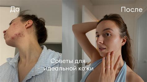 Шея и подростковые акне: советы по уходу