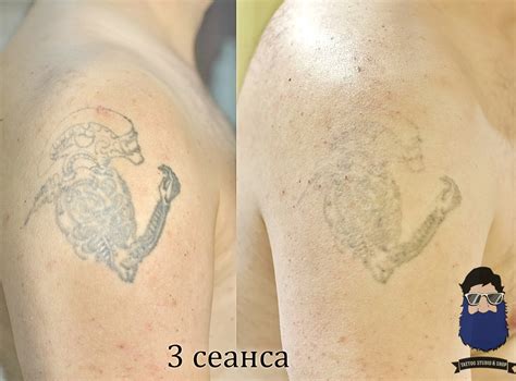 Эффективные способы удаления татуировки от жвачки